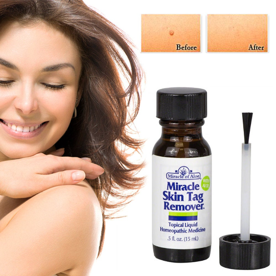 MIRACLE SKIN TAG REMOVER